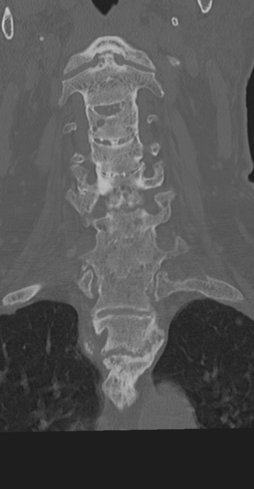 Cervical spine fracture in the setting of ankylosis (Radiopaedia 37038-38715 Coronal bone window 30).png