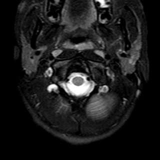 File:Cervical spine posterior ligamentous complex rupture (Radiopaedia 63486-72103 Axial T2 24).jpg