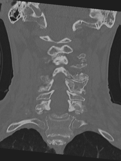 Cervical spondylolysis (Radiopaedia 49616-54811 Coronal bone window 28).png