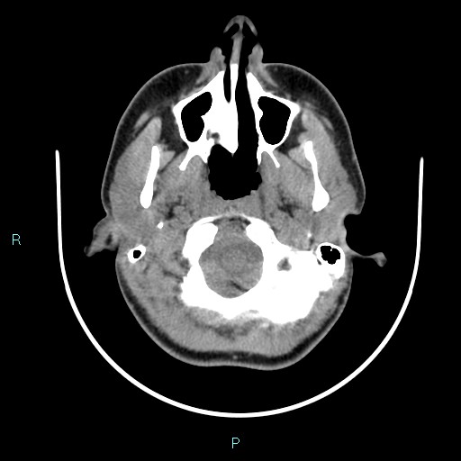 File:Cervical thymic cyst (Radiopaedia 88632-105335 Axial non-contrast 100).jpg