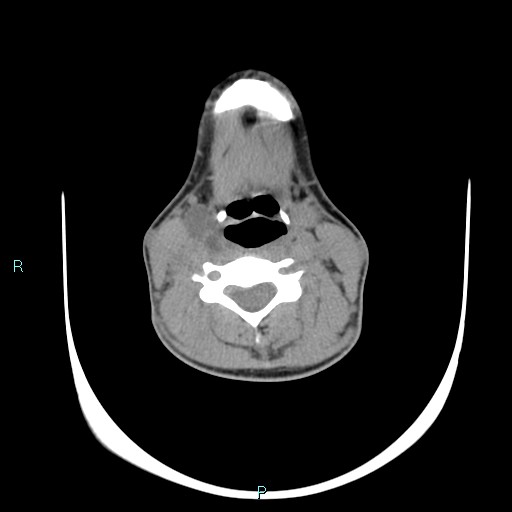 Cervical thymic cyst (Radiopaedia 88632-105335 Axial non-contrast 63).jpg