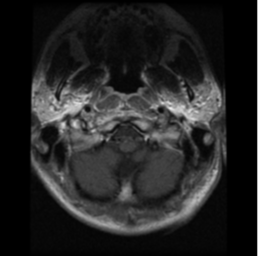 File:Cervical vertebrae metastasis (Radiopaedia 78814-91667 Axial T1 C+ 28).png