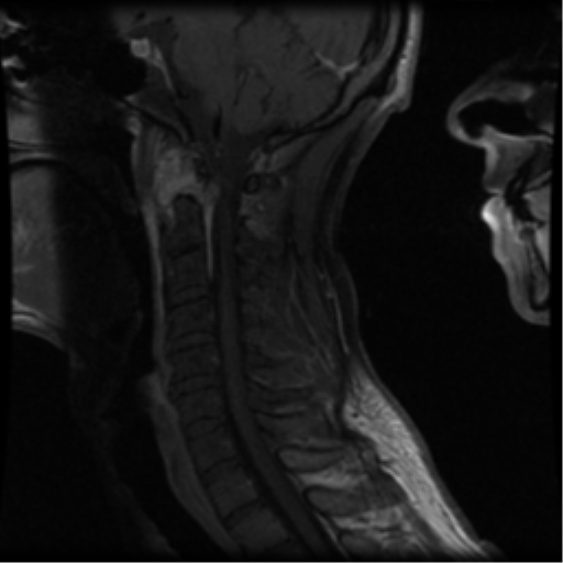 File:Cervical vertebrae metastasis (Radiopaedia 78814-91667 G 8).png