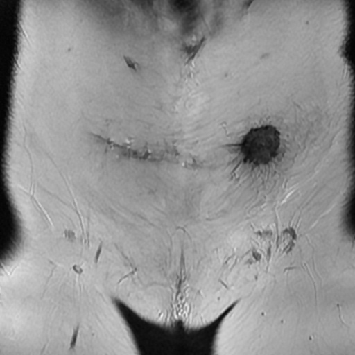 File:Cesarian section scar endometriosis (Radiopaedia 66520-75799 Coronal T2 4).jpg