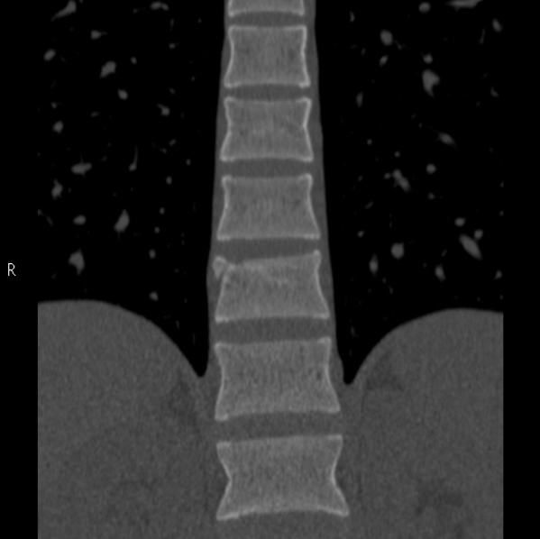 Chance fracture (Radiopaedia 36521-38081 Coronal bone window 20).jpg
