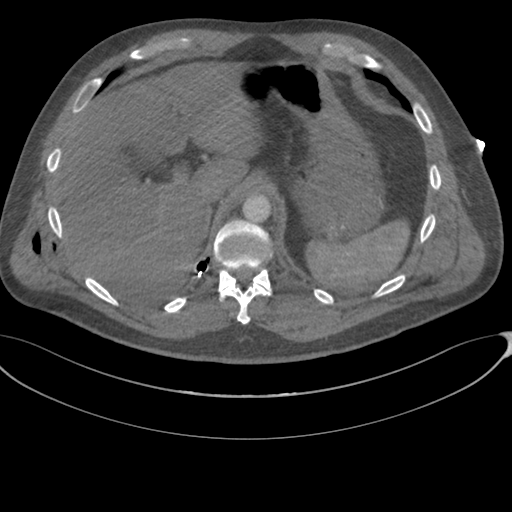 File:Chest multitrauma - aortic injury (Radiopaedia 34708-36147 A 277).png