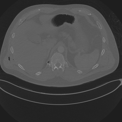 File:Chest multitrauma - aortic injury (Radiopaedia 34708-36147 Axial bone window 287).png