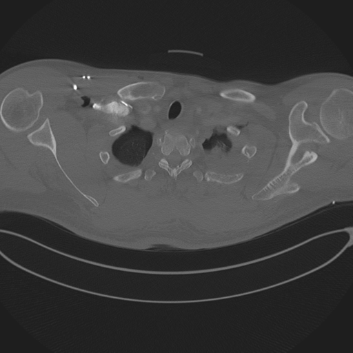 Chest multitrauma - aortic injury (Radiopaedia 34708-36147 Axial bone window 32).png