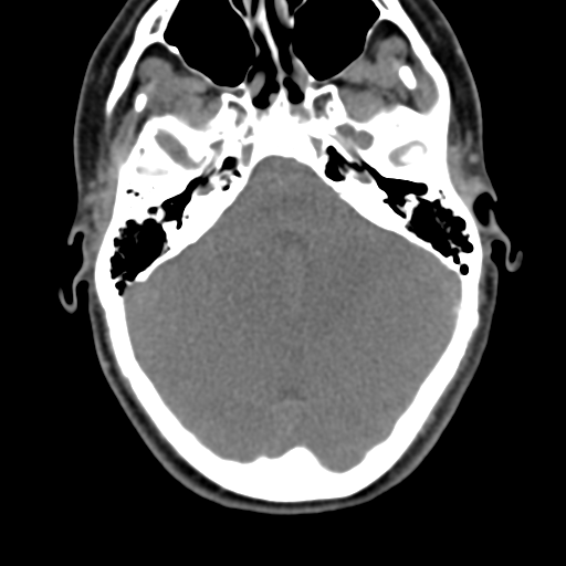 File:Chiari I malformation and obstructive hydrocephalus (Radiopaedia 41185-43981 D 23).png