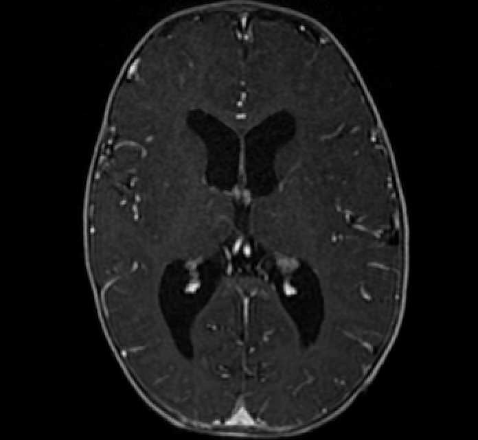 Chiasmatic-hypothalamic glioma (Radiopaedia 90079-107252 Axial T1 C+ 48).jpg