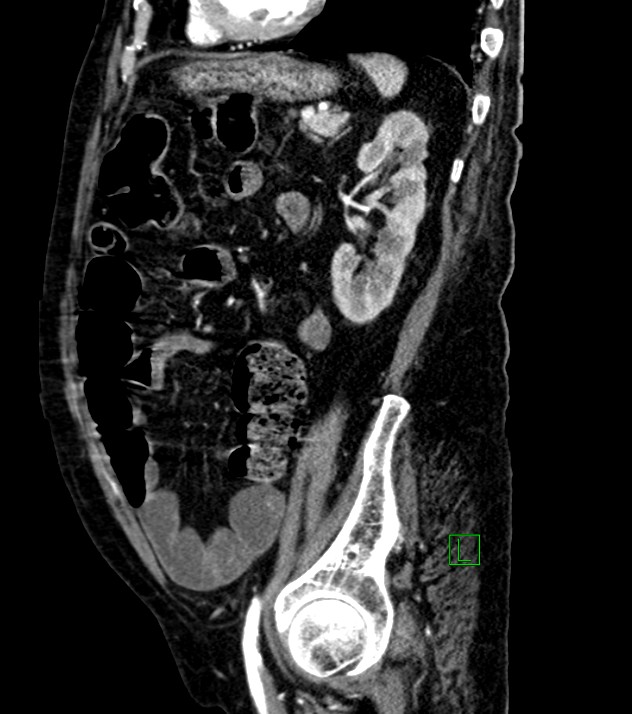 Cholangiocarcinoma with cerebral metastases (Radiopaedia 83519-98629 F 40).jpg