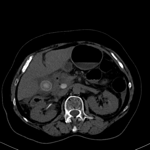 File:Cholecystitis - obstructive choledocholitiasis (CT intravenous cholangiography) (Radiopaedia 43966-47479 Axial 96).png