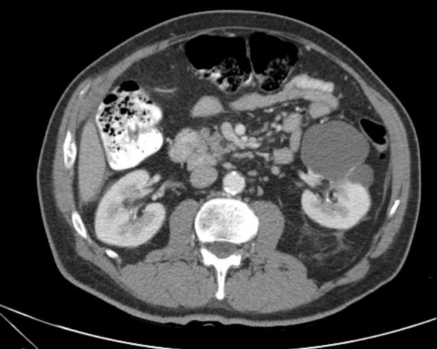 File:Cholecystitis - perforated gallbladder (Radiopaedia 57038-63916 A 40).jpg
