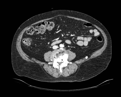 Cholecystoduodenal fistula (Radiopaedia 48959-54022 A 10).jpg