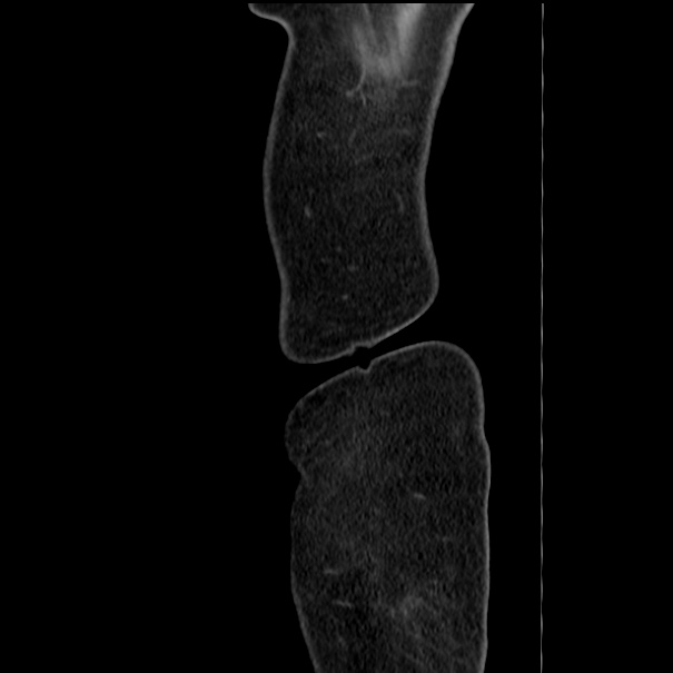 Choledocholithiasis on CT and MRI (Radiopaedia 24825-25087 D 2).jpg