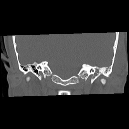 Cholesteatoma (Radiopaedia 84960-100474 Coronal bone window 29).jpg