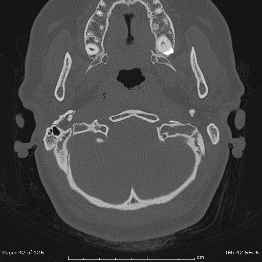 Cholesteatoma - external auditory canal (Radiopaedia 88452-105096 Axial bone window 5).jpg