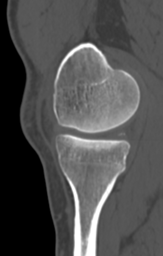 Chondrocalcinosis (Radiopaedia 82862-97173 Sagittal bone window 17).jpg