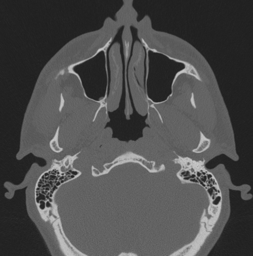 File:Chondrosarcoma (clivus) (Radiopaedia 46895-51425 Axial bone window 64).png