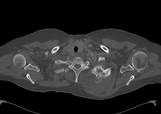 File:Chondrosarcoma - chest wall (Radiopaedia 65192-74199 Axial bone window 13).jpg