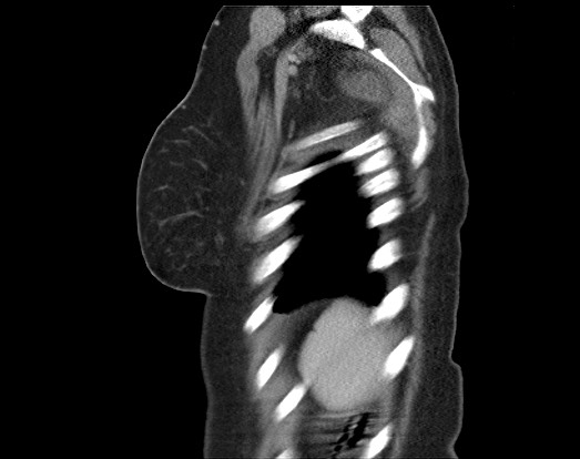 Chondrosarcoma - chest wall (Radiopaedia 65192-74199 B 9).jpg