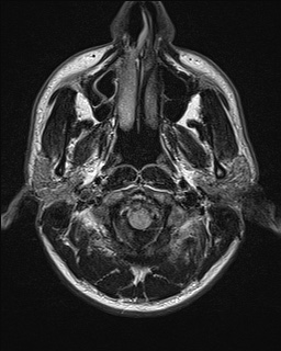 File:Chondrosarcoma - sphenoid wing (Radiopaedia 58259-67947 Axial FLAIR 1).jpg
