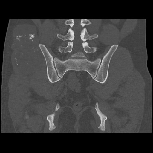 Chondrosarcoma of iliac wing (Radiopaedia 63861-72599 Coronal bone window 78).jpg