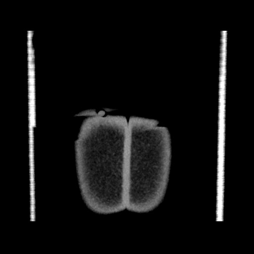Chondrosarcoma of iliac wing (Radiopaedia 63861-72599 Coronal non-contrast 117).jpg