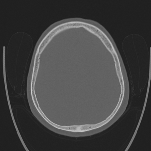 Chondrosarcoma of skull base- grade II (Radiopaedia 40948-43653 Axial bone window 35).png
