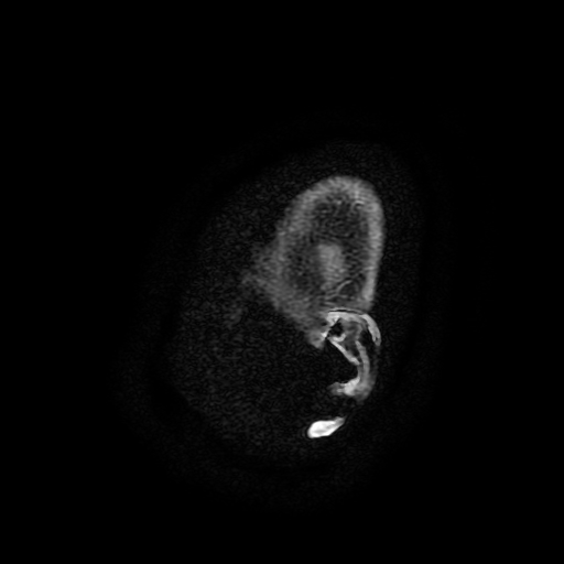 Chordoid glioma of third ventricle (Radiopaedia 91612-109340 F 205).jpg
