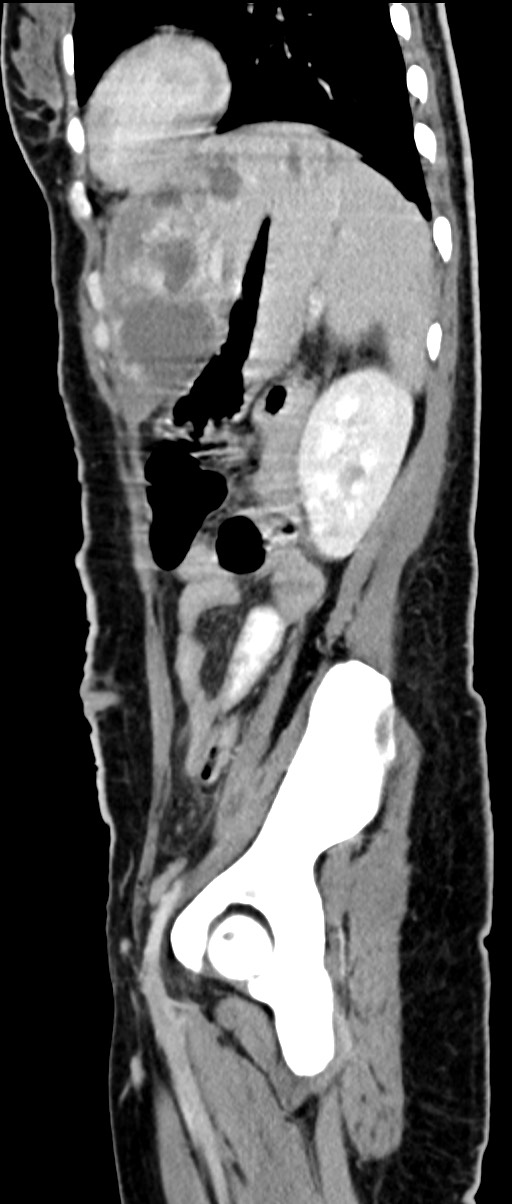 Choriocarcinoma liver metastases (Radiopaedia 74768-85766 C 67).jpg