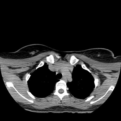 File:Choriocarcinoma of ovary with cerebral and pulmonary metastases (Radiopaedia 25983-26119 Axial non-contrast 94).jpg
