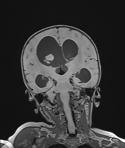 Choroid plexus papilloma (Radiopaedia 84612-100019 Coronal FLAIR 74).jpg