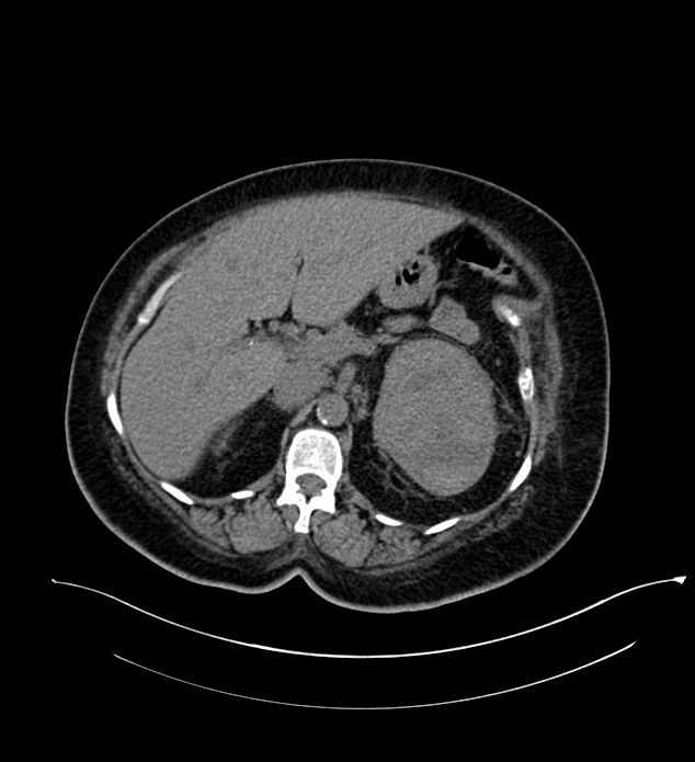 Chromophobe renal cell carcinoma (Radiopaedia 84239-99519 Axial non-contrast 59).jpg