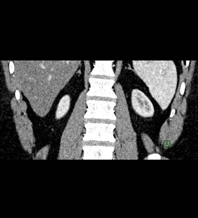 Chromophobe renal cell carcinoma (Radiopaedia 84286-99573 E 70).jpg