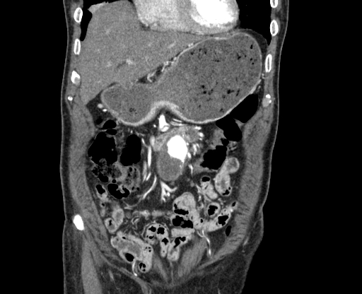 Chronic contained rupture of abdominal aortic aneurysm with extensive erosion of the vertebral bodies (Radiopaedia 55450-61901 D 9).jpg