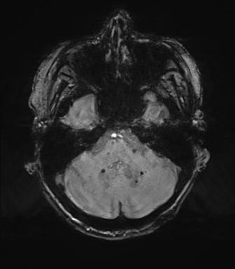 Chronic hypertensive encephalopathy (Radiopaedia 72844-83495 Axial SWI magnitude 19).png