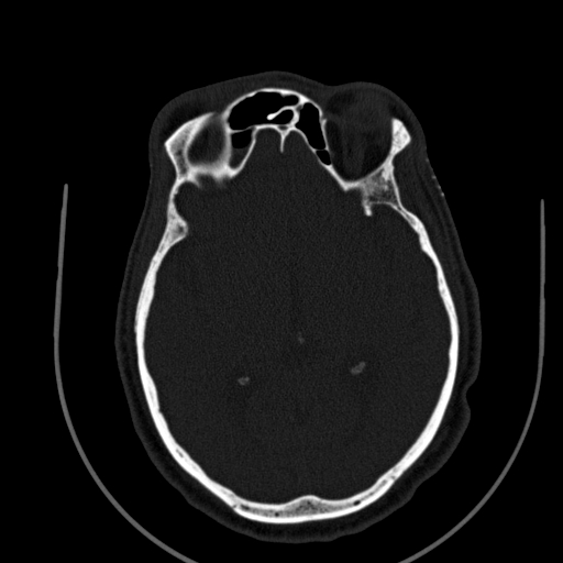 Chronic invasive fungal sinusitis (Radiopaedia 91563-109286 Axial sinus 120).jpg