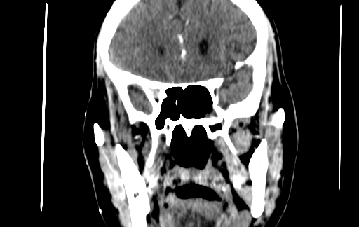 Chronic invasive fungal sinusitis (Radiopaedia 91563-109286 D 78).jpg