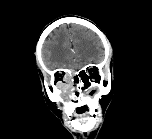 Chronic invasive fungal sinusitis with intraorbital and intracranial extension (Radiopaedia 56387-63046 C 107).jpg