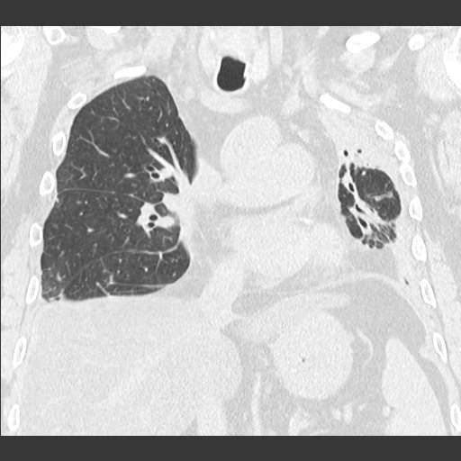 File:Chronic lung allograft dysfunction - restrictive form (Radiopaedia 60595-68316 Coronal lung window 53).jpg