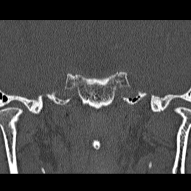 Chronic maxillary sinusitis (Radiopaedia 27879-28116 Coronal bone window 57).jpg