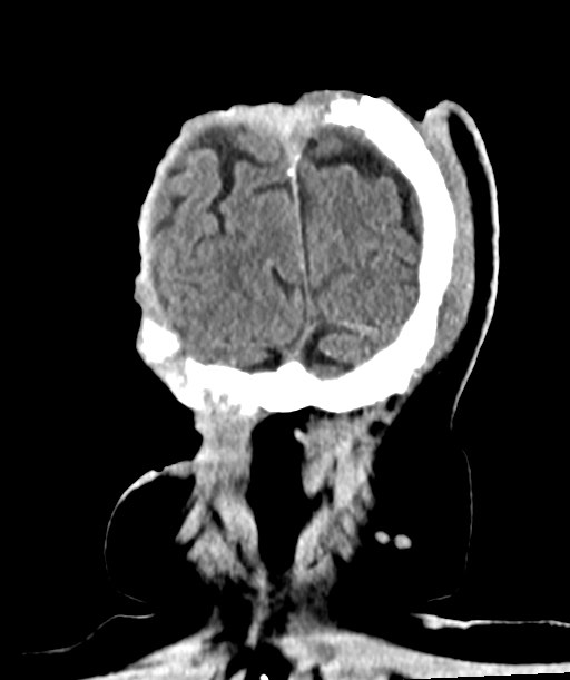 Chronic osteomyelitis - calvarial (severe) (Radiopaedia 69668-79616 Coronal non-contrast 62).jpg