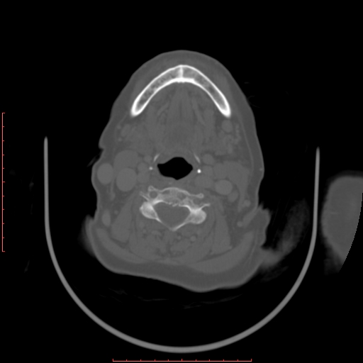 Chronic osteomyelitis - maxilla (Radiopaedia 23783-23927 Axial bone window 17).jpg