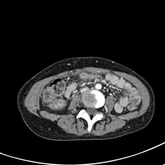 File:Chronic pancreatitis (Radiopaedia 55405-61846 A 60).jpg