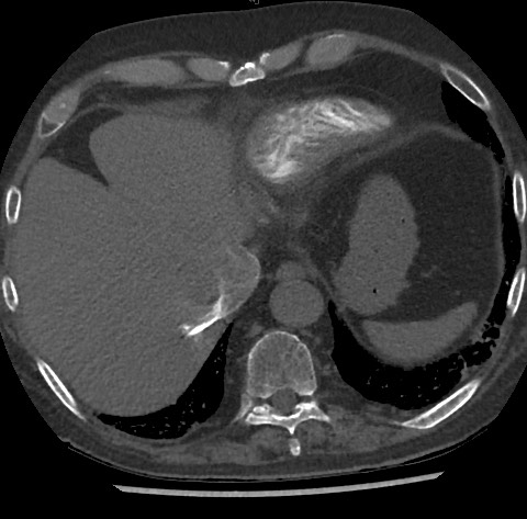 Chronic thromboembolic pulmonary disease (Radiopaedia 90694-108119 Axial C+ CTPA 82).jpg