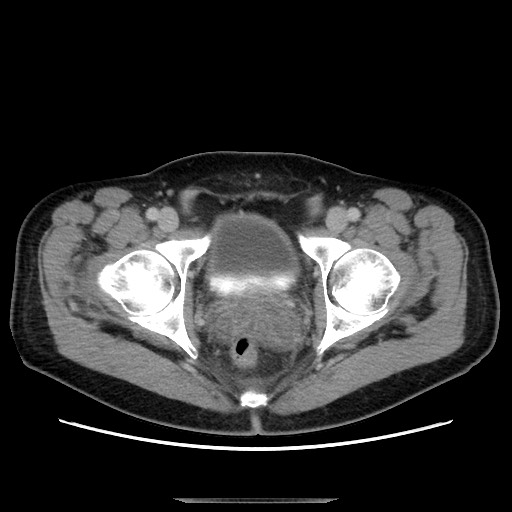 File:Chronic ureteropelvic junction obstruction (Radiopaedia 78365-90996 A 126).jpg