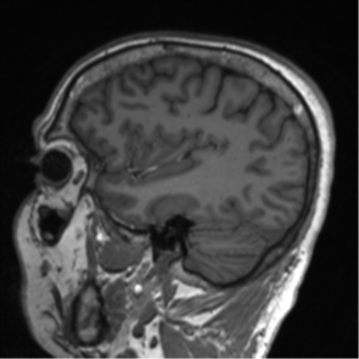 Clival chordoma invading the hypoglossal canal (Radiopaedia 48850-53887 Sagittal T1 70).png