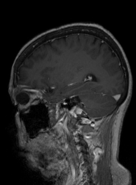 Clival meningioma (Radiopaedia 53278-59248 Sagittal T1 C+ 205).jpg