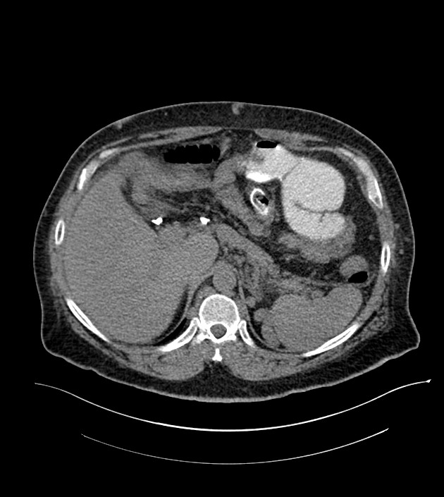 Closed-loop small bowel obstruction-internal hernia (Radiopaedia 78439-91096 Axial non-contrast 39).jpg